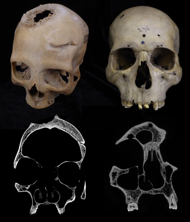 Un estudo da USC revela posibles tratamentos de cancro en cranio exipcio de 4.000 anos